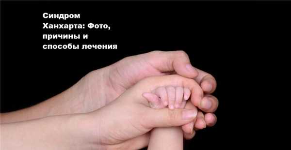 синдром ханхарта фото у детей
