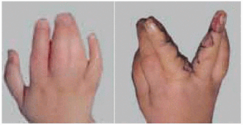 Гиподактилия фото у детей