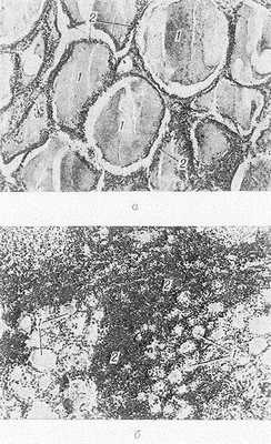 Рис. Микропрепараты щитовидной железы в норме (а) и при болезни Хасимото (б): а — фолликулы щитовидной железы заполнены коллоидом (1) и выстланы эпителием (2); б — фолликулы щитовидной железы резко уменьшены в размерах, содержат бледный коллоид (1), в строме наблюдается диффузная инфильтрация лимфоидными и плазматическими клетками (2), окраска гематоксилин-эозином; х 70.