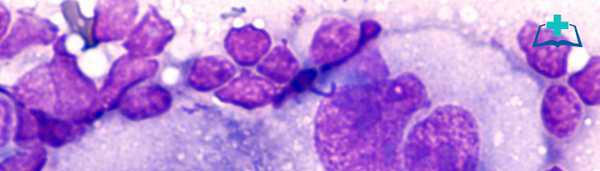 Определение, эпидемиология и иммуноморфологическая характеристика лимфомы Ходжкина