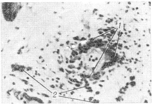 Продуктивный васкулит при гигантоклеточном артериите. Среди клеток воспалительного пролиферата стенки мелкой артерии миокарда (2) видны гигантские многоядерные клетки (2).