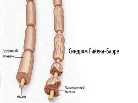 Синдром Гийена — Барре