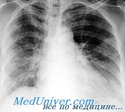 жировая эмболия