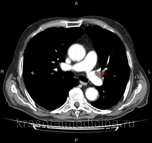 Воздушная эмболия