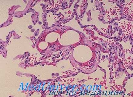 жировая эмболия