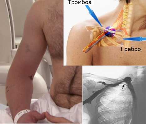 Почему возникает тромбоз подключичной вены