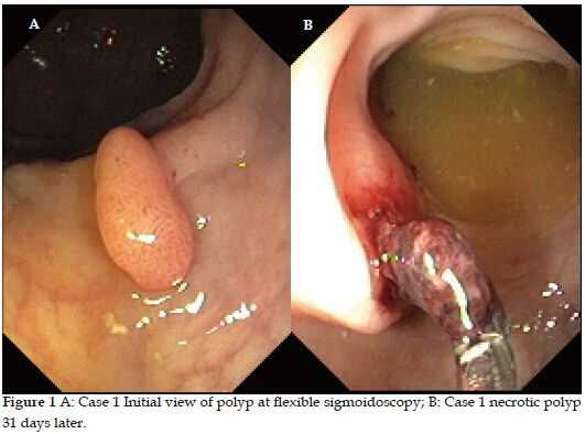 Перерождение полипа в рак