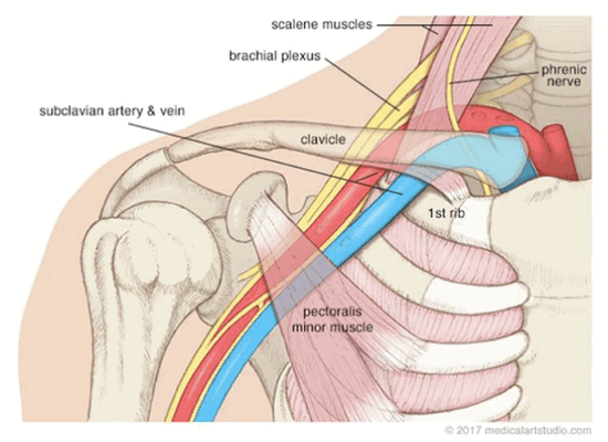 тест адсона - диагностика синдрома верхней апертуры грудной клетки