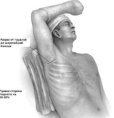 Больной укладывается с под углом 20 - 30 градусов рука максимально отводится.