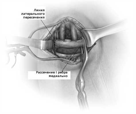 После освобождения ребра от всех окружающих мышц оно пересекается в медиальном и латеральном конце