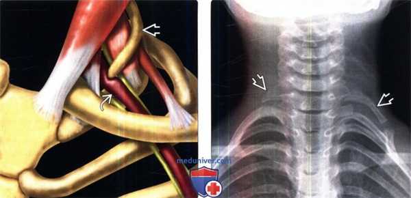 Рентгенограмма, МРТ при синдроме верхней апертуры грудной клетки