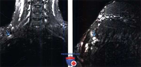 Рентгенограмма, МРТ при синдроме верхней апертуры грудной клетки