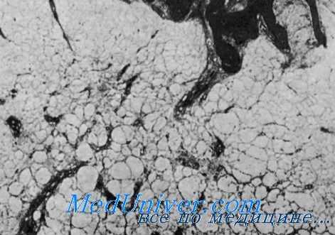 синдром хантер