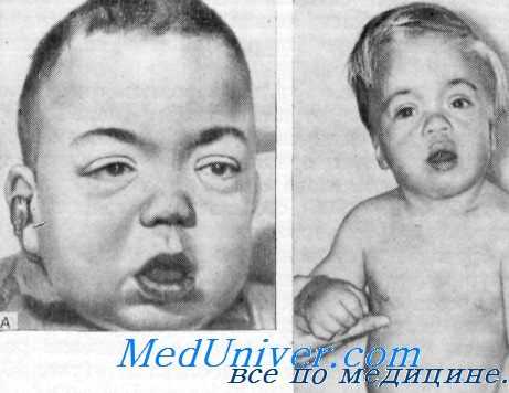 гипоталамо-гипофизарная карликовость