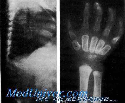 мукополисахаридоз