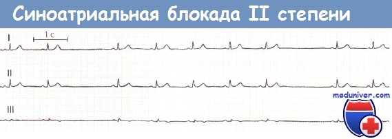 Синоатриальная блокада второй (II) степени