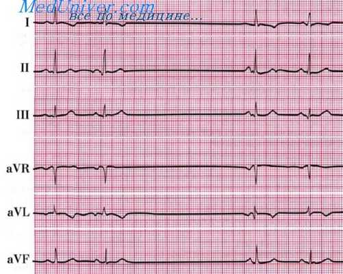 синоатриальная блокада