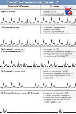 Синоатриальные блокады на ЭКГ