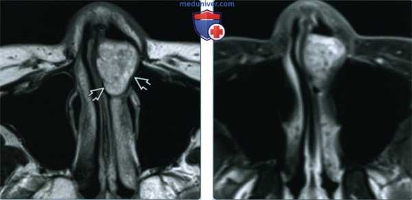 Синоназальная доброкачественная смешанная опухоль - лучевая диагностика