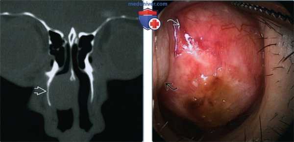 Синоназальная доброкачественная смешанная опухоль - лучевая диагностика