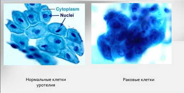 Раковые клетки