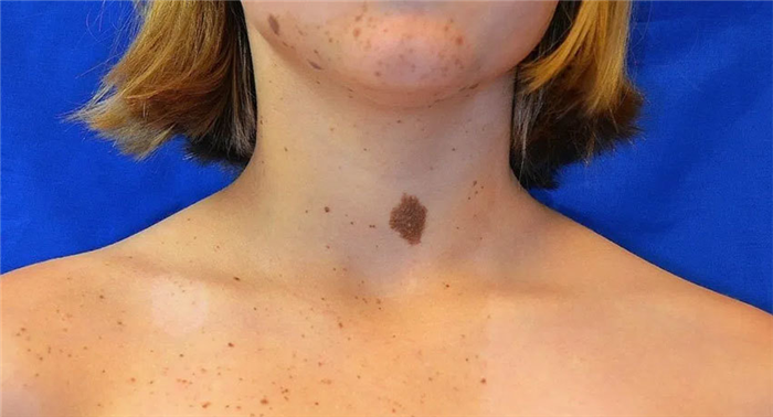 Пигментные невусы