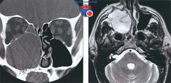 Лучевая диагностика аденокистозного рака носа и околоносовых пазух