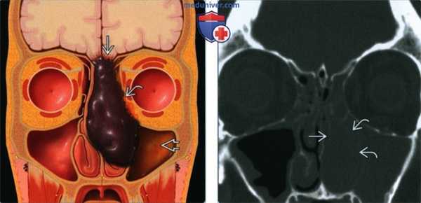 Синоназальная меланома - лучевая диагностика
