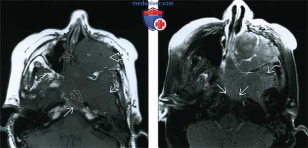 КТ, МРТ при синоназальном плоскоклеточном раке