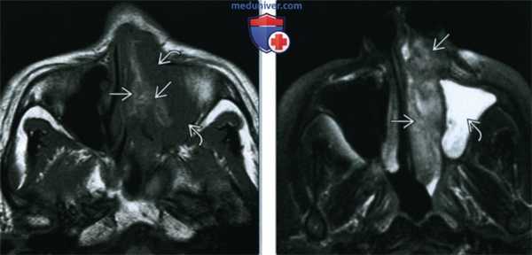 Синоназальная меланома - лучевая диагностика