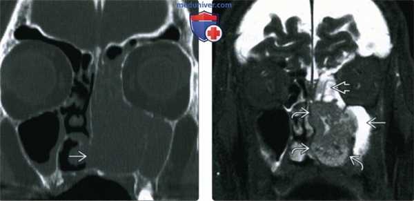 КТ, МРТ при синоназальном плоскоклеточном раке