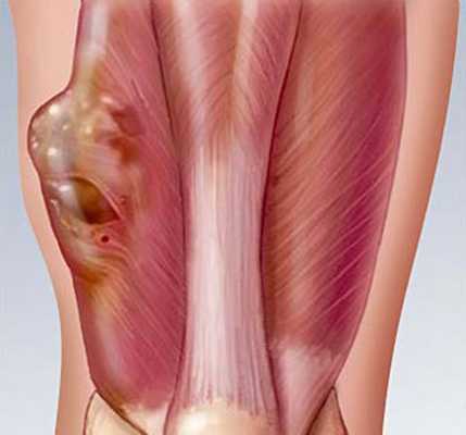 Саркомы мягких тканей