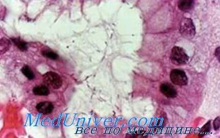 надпочечники при язве желудка