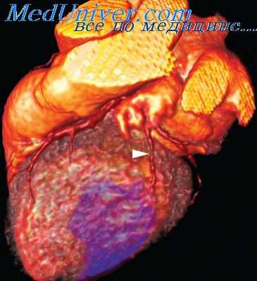 дилатация левого желудочка