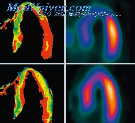 перфузия миокарда