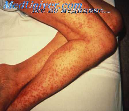 тромбоцитопении