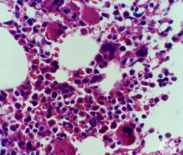 Увеличением количества мегакариоцитов в биоптате костного мозга при тромбоцитопенической пурпуре