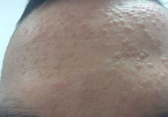 Сирингома, плоские бородавки