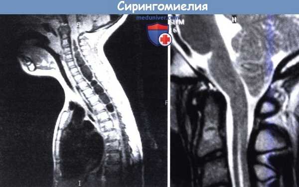 Сирингомиелия