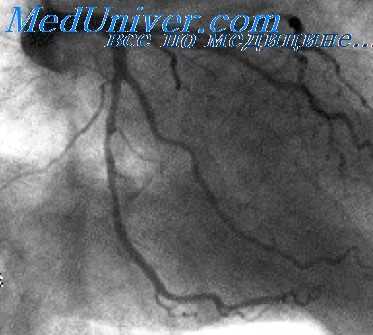инфаркт миокарда