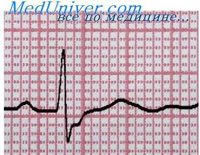 неотложная помощь при остром коронарном синдроме