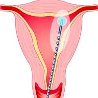Микроволновая аблация эндометрия (МЕА)