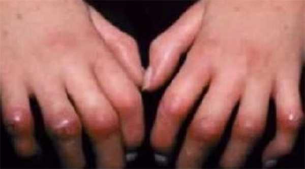 Склеродермия