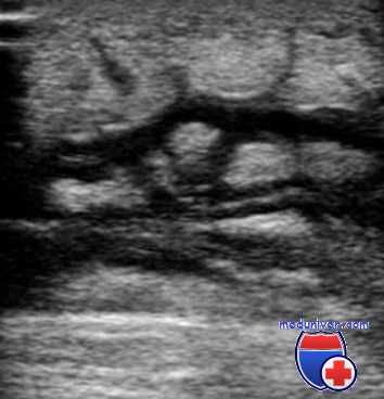 гнойная инфекция