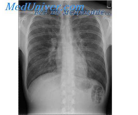 медиаторы и воспаление