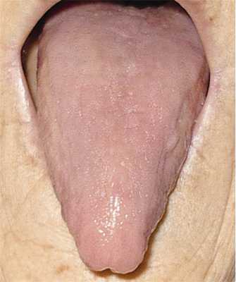 Рис. 3. «Лакированный» язык у больной В12-дефицитной анемией.