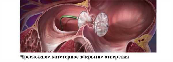 Чрескожное катетерное закрытие отверстия