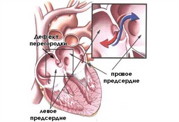 Дефект перегородки