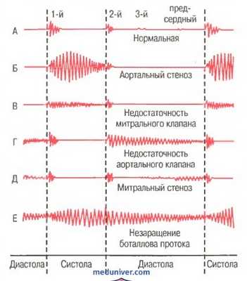Тоны сердца. Причины возникновения первого и второго тонов сердца