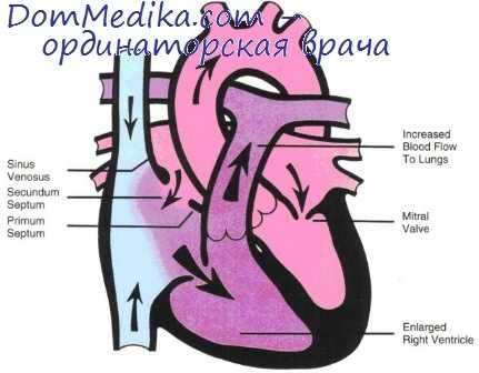 дефект межпредсердной перегородки